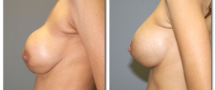 breast-revision1654a