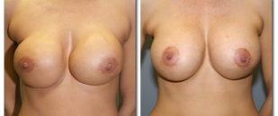 breast-revision1654b