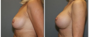revision-breast5874a