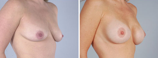 Breast Before & After