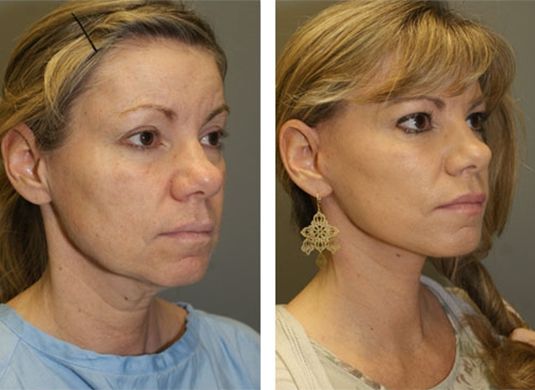 Facelift Patient