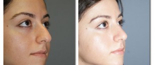 before and after photo of rhinoplasty