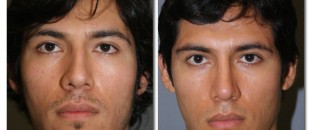 before and after photo of rhinoplasty