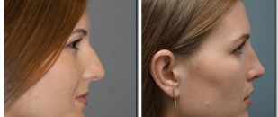 before and after photo of rhinoplasty