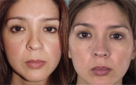 Rhinoplasty — Surgery of the Nose