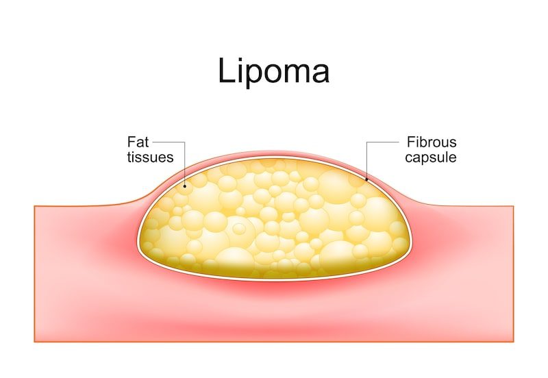 Illustration-of-a-lipoma.