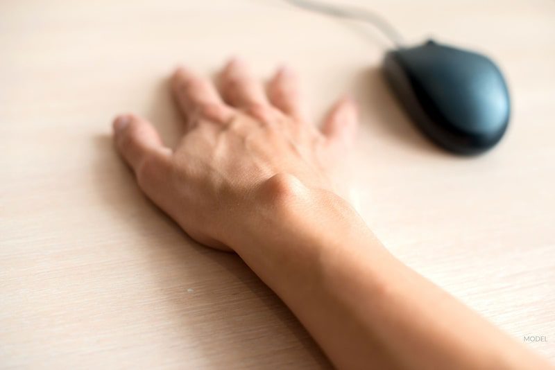 Lipoma on a woman's wrist