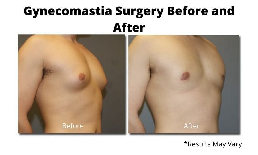 Before and after image showing the results of a gynecomastia surgery on a 25-year-old male in Washington, DC.