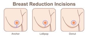 Illustration showing the various breast reduction incision types.