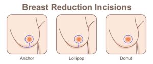 Surgical incisions for reduction mammoplasty. (a) An incision is