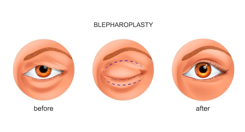 Illustrated drawing showing what the results are like after an eyelid surgery.