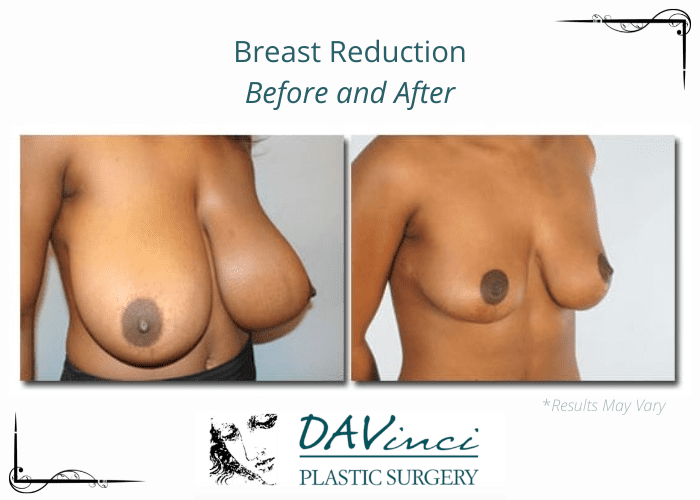 Breast reduction before and after image performed in Washington DC.