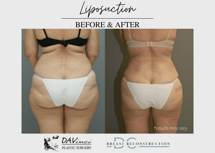 Before and after image showing the results of a liposuction treatment performed in Washington DC.