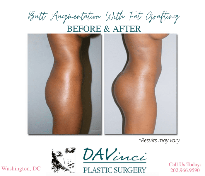 Before and after image showing the results of a Brazilian Butt Lift performed in Washington, DC.
