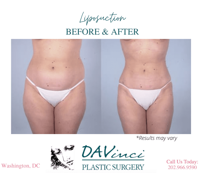 Before and after image showing the results of a liposuction treatment performed in Washington, DC.