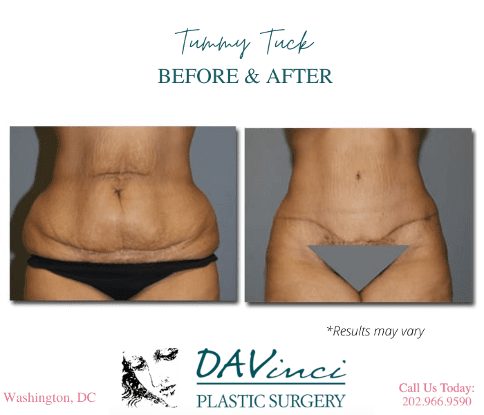Before and after image showing the results of a tummy tuck performed in Washington, DC.