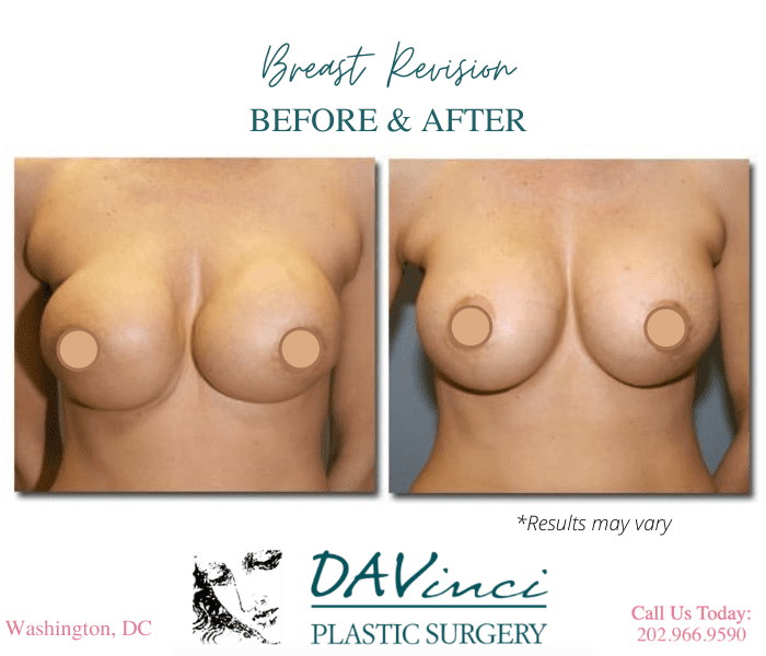 Before and after image showing the results of a breast revision performed in Washington DC