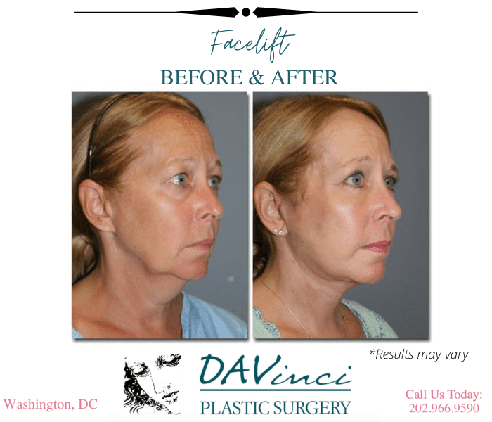 Before and after image showing the results of a facelift performed in Washington DC.