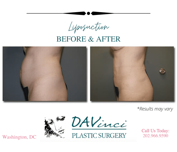 Before and after showing liposuction results in Washington DC.