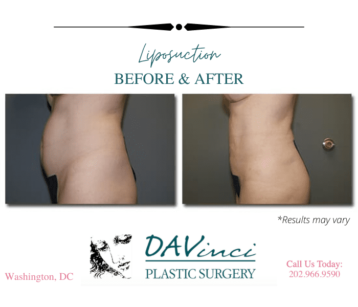 Seattle Liposuction Abdomen & Waist