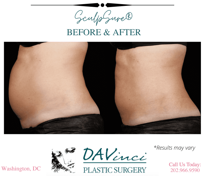 Before and after results showing SculpSure in Washington DC.