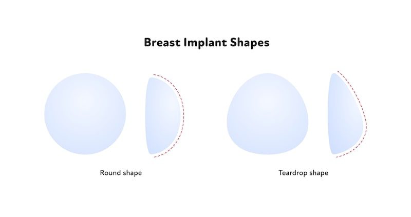 Illustration of breast implant shapes.