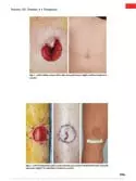 Illustrations: Periumbilical Full-Thickness Skin Graft Donor Site for Pretibial Skin Cancer Excisions