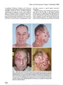 Article: Herpes Zoster after Reconstruction for Head and Neck Cancer