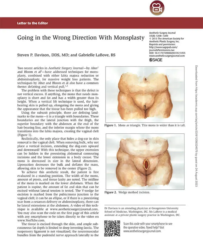 Article: Going in the wrong direction with monsplasty