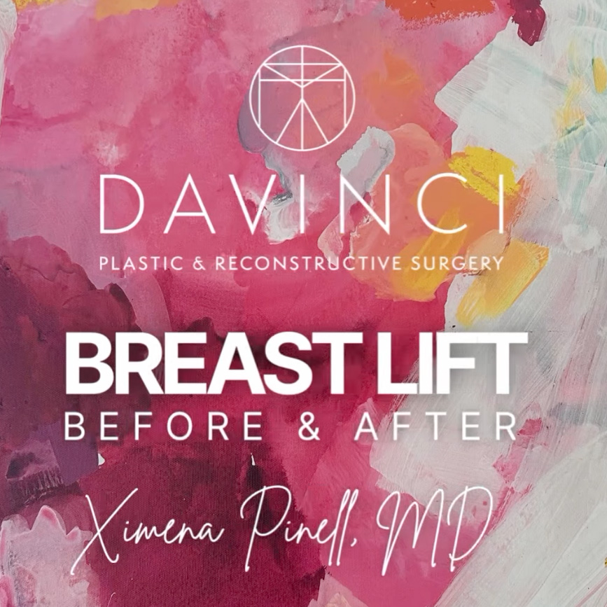 Breast Lift Before and after