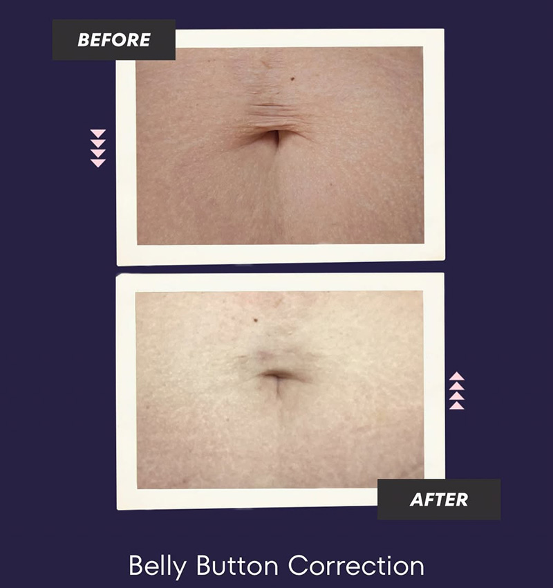Belly Button Correction instagram post