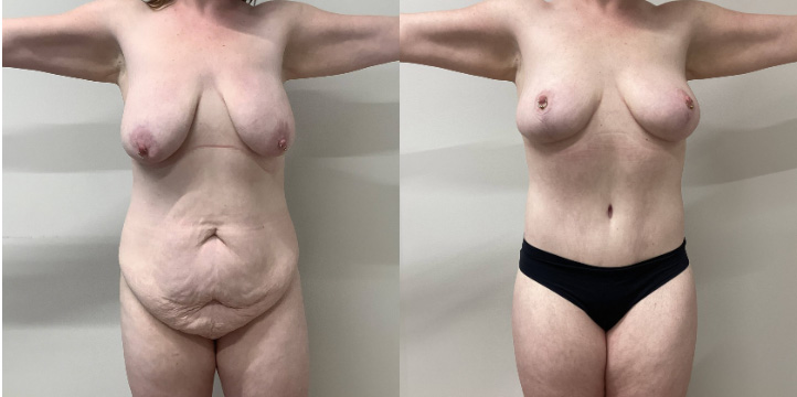 weight loss before and after