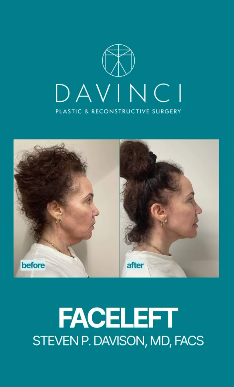 Facelift Before and After Patient