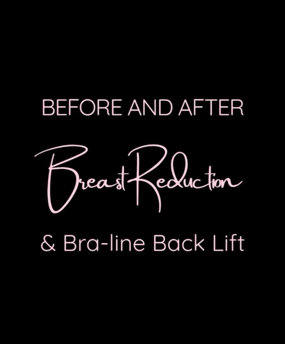 Sometimes, a breast reduction isn’t quite enough.
