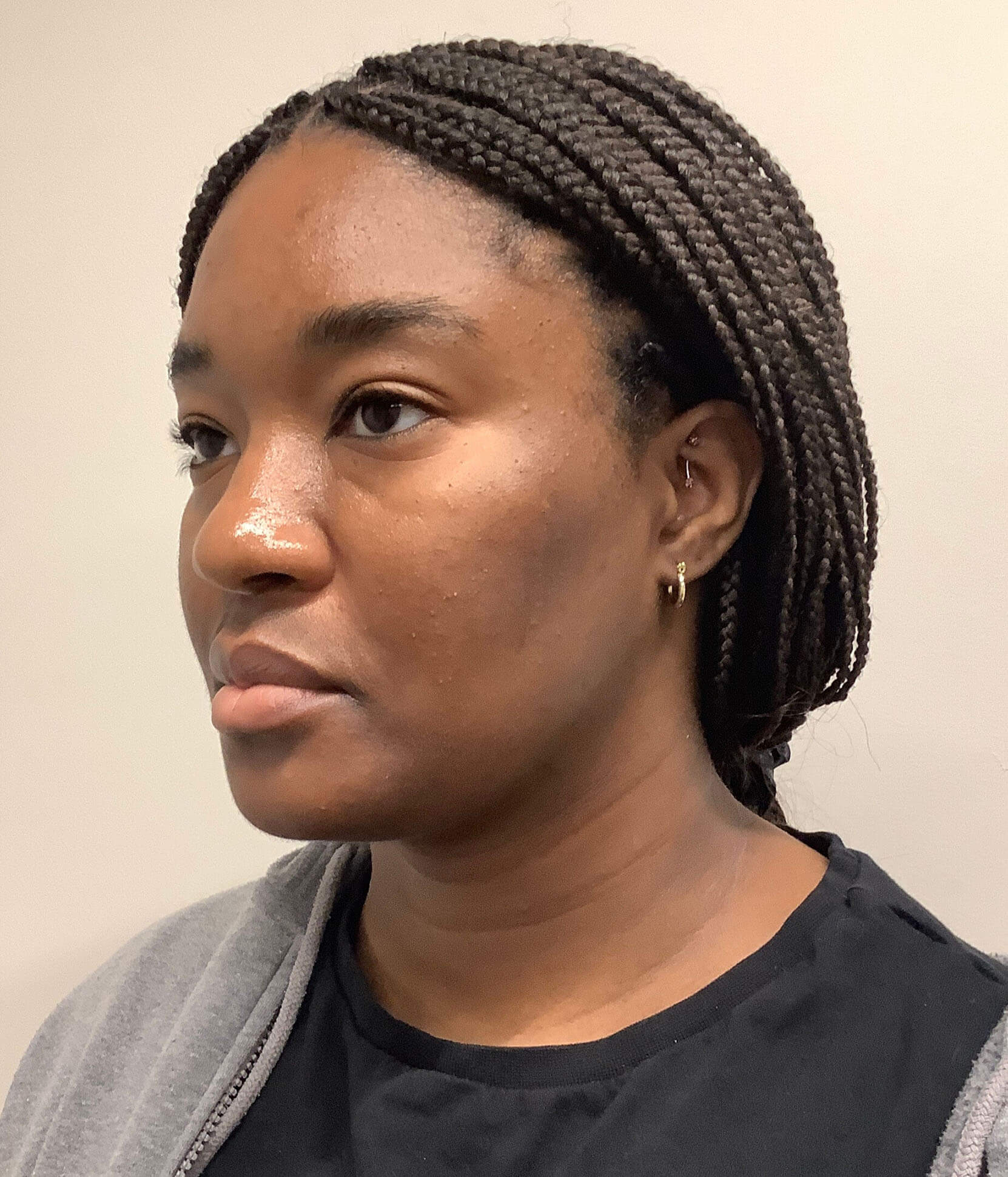 Case--3944 | After Submental Liposuction