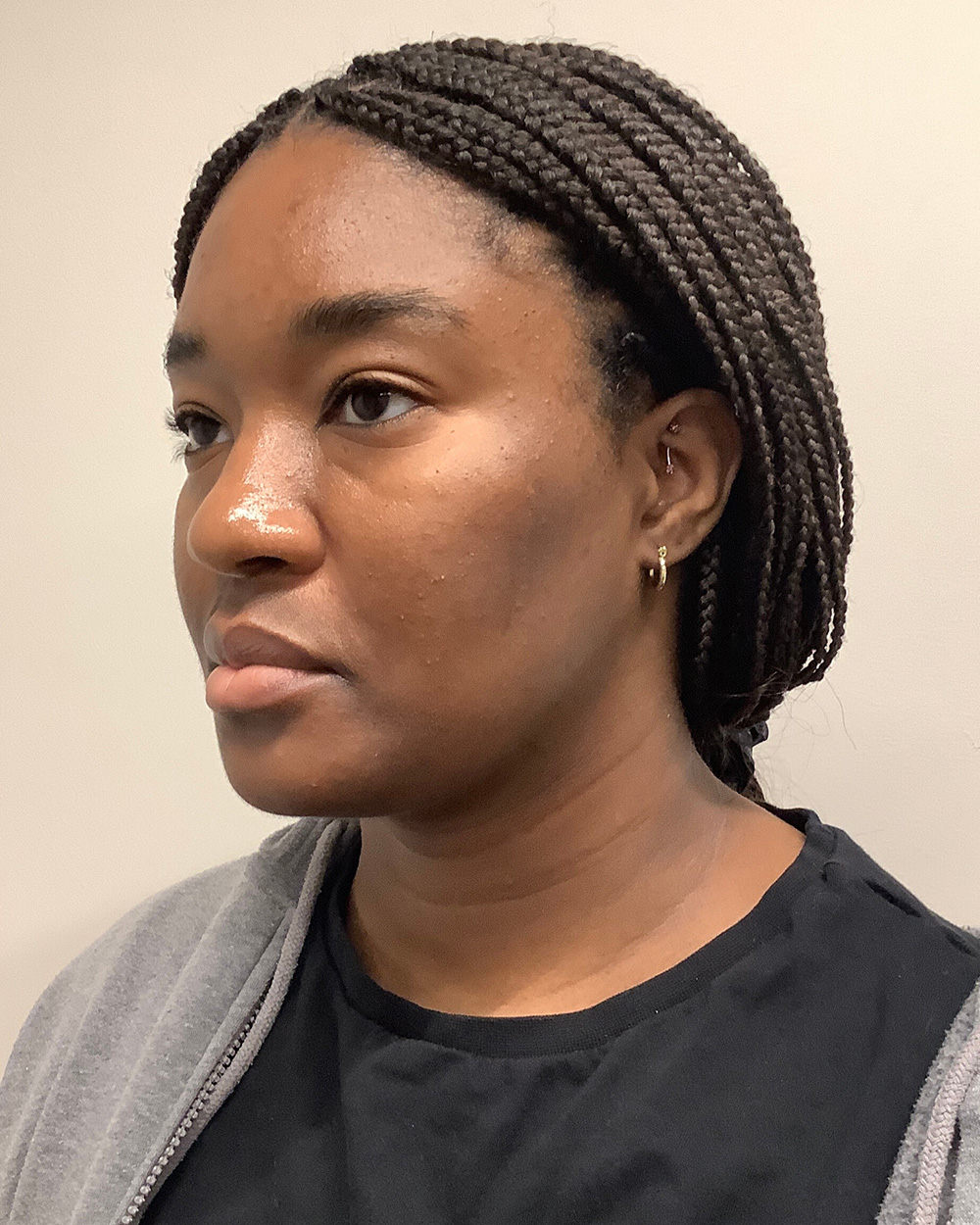 Case--9954 | After Liposuction