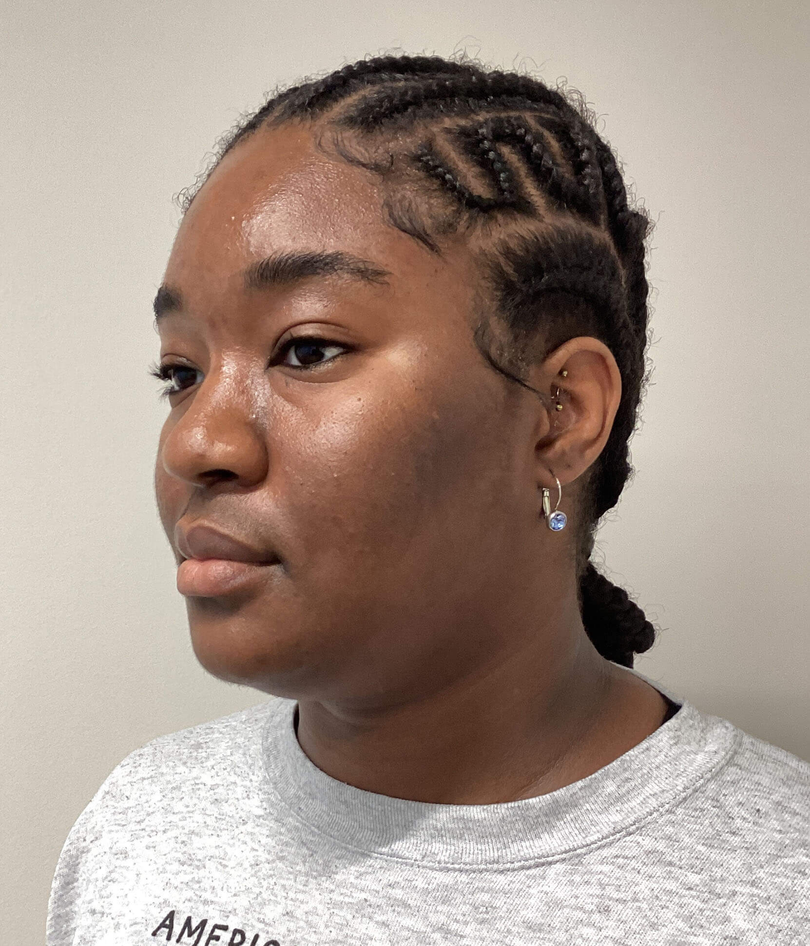 Case--3944 | Before Submental Liposuction