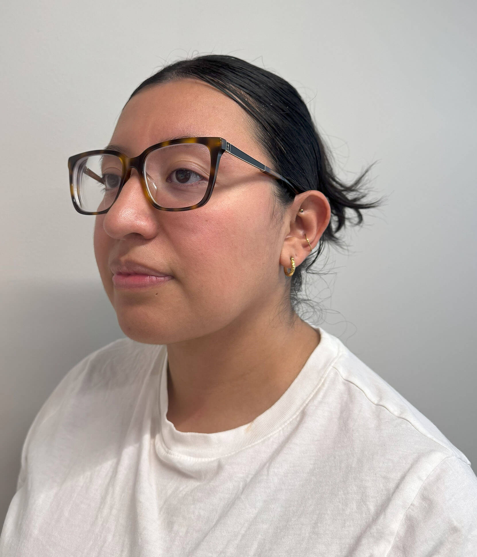 Case--1744 | After Submental Liposuction