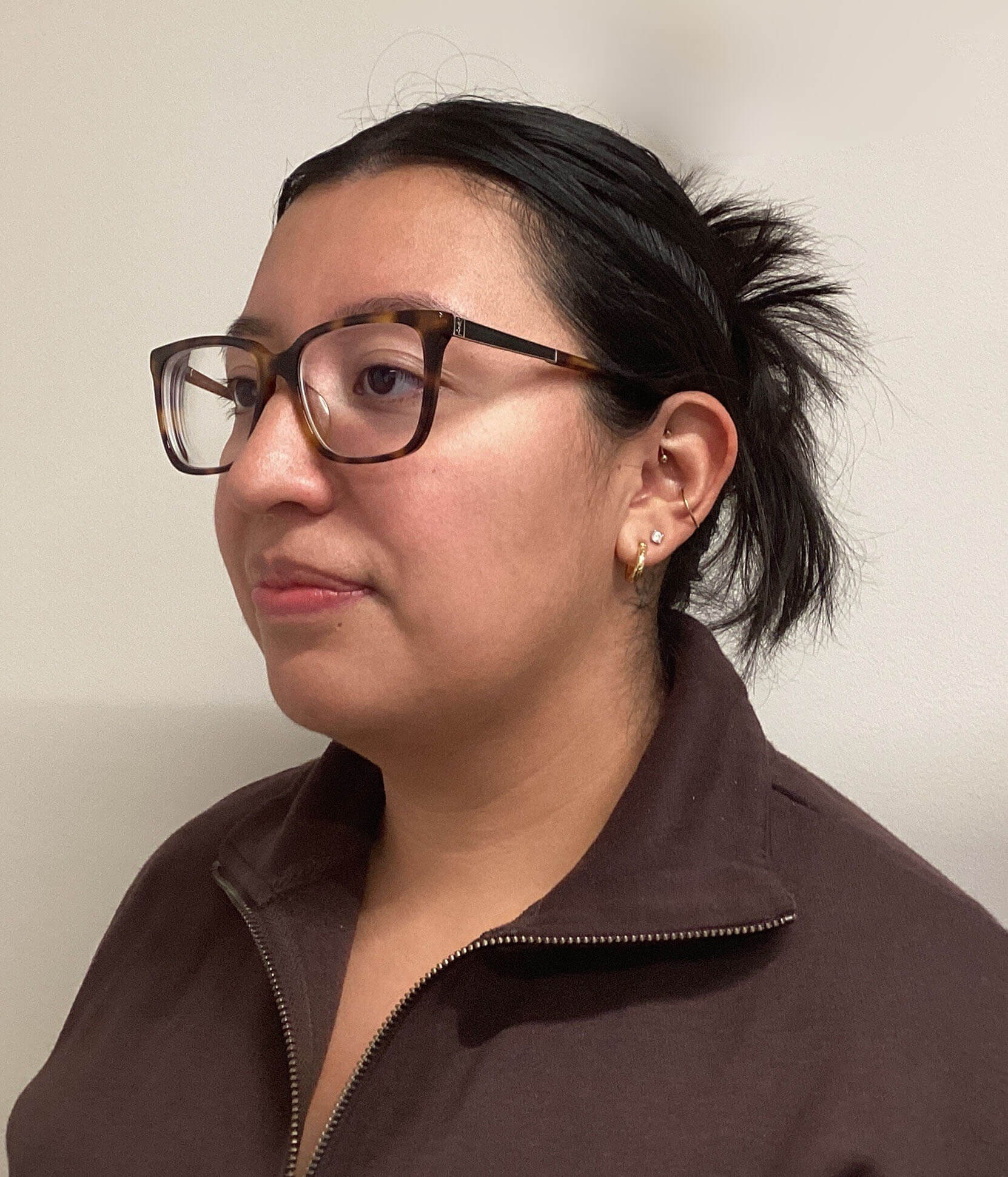 Case--1744 | Before Submental Liposuction