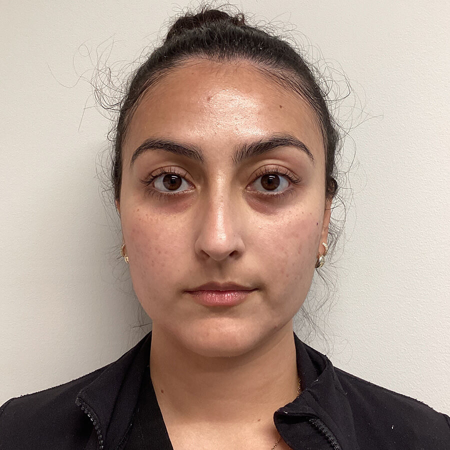 Case--7021 | Before Microneedling