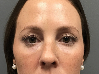 Case--6212 | After Eye Filler