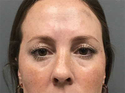 Case--6212 | Before Eye Filler