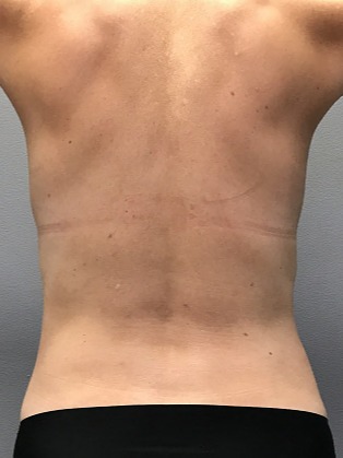 Liposuction-Patient-3 | After Liposuction