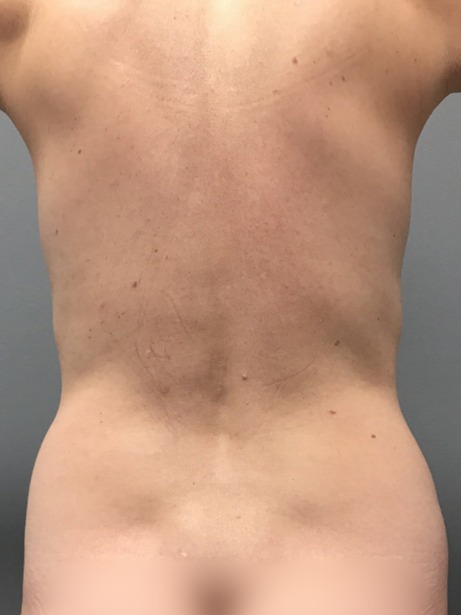 Liposuction-Patient-3 | Before Liposuction