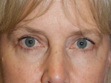 Eyelid-Surgery-Patient-3 | After Eyelids