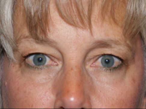 Eyelid-Surgery-Patient-3 | Before Eyelids