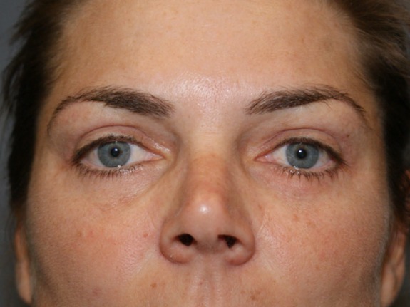 Eyelid-Surgery-Patient-4 | After Eyelids