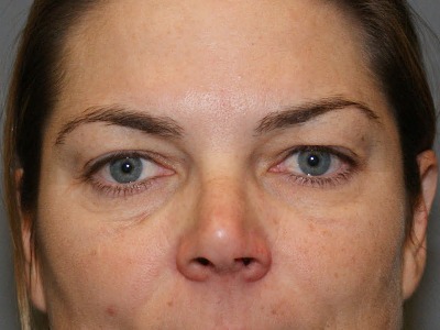 Eyelid-Surgery-Patient-4 | Before Eyelids