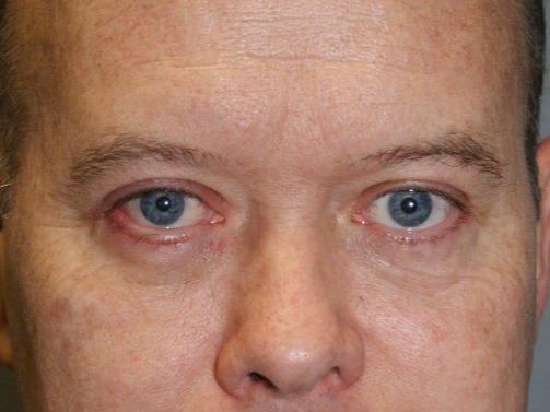 Eyelid-Surgery-Patient-5 | After Eyelids