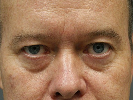 Eyelid-Surgery-Patient-5 | Before Eyelids